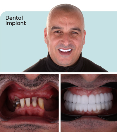 full teeth implant with mcan dental 