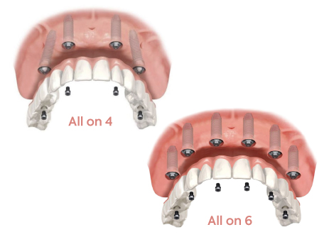 All-on-4 en All-on-6 Tandimplantaten