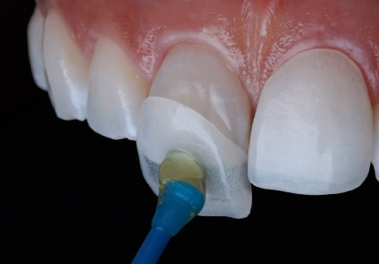Emax Facings