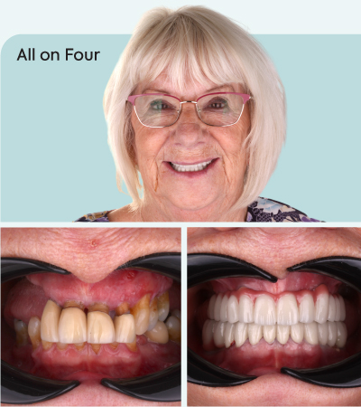 mcan dental all on 4 before after