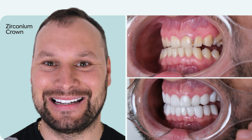 tandheelkundige behandeling in turkije met mcan dental