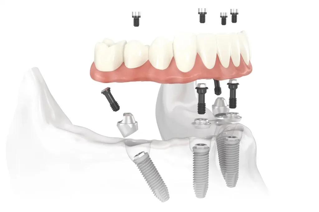 all on 4 dental implants in turkey