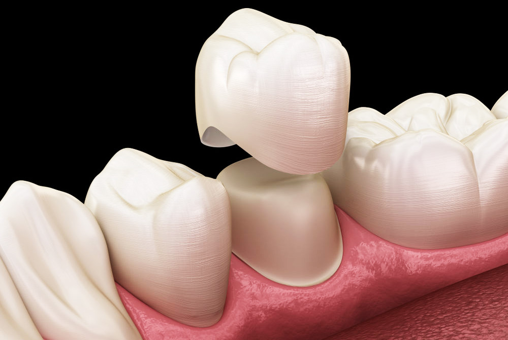 zirconia crowns placement 