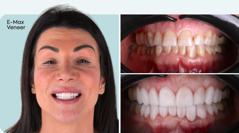 mcan dental before and after dental veneers 