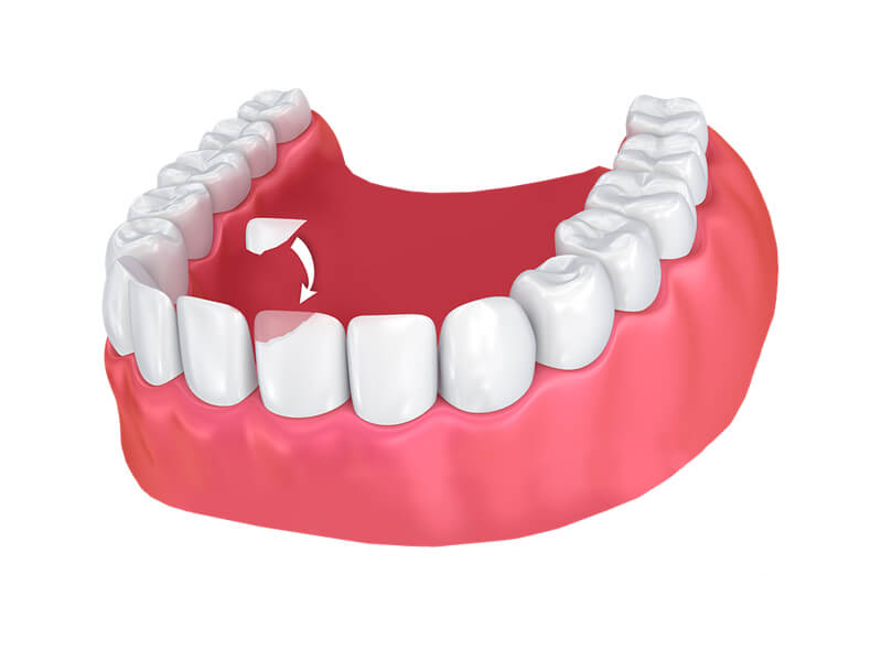 teeth bonding picture