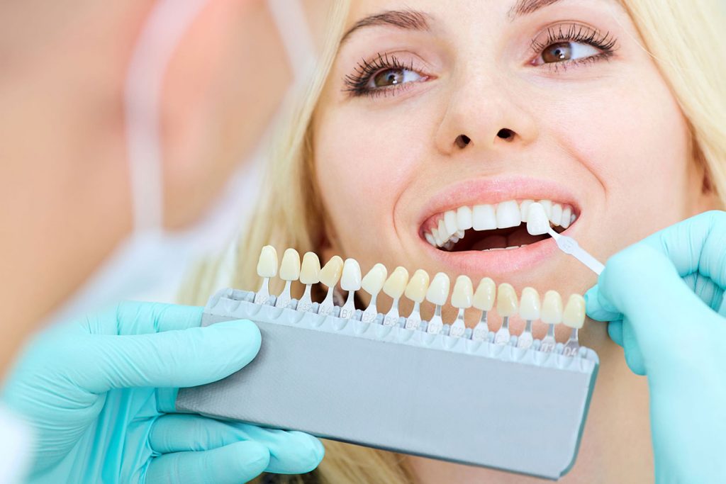 choosing the color of dental veneers 