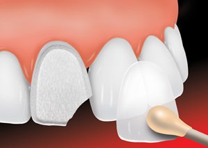 dental veneers picture 