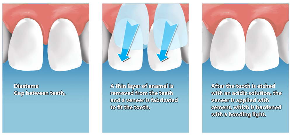 dental veneers removing of enamel 