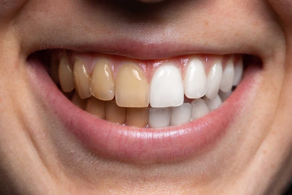 dental treatments before and after 