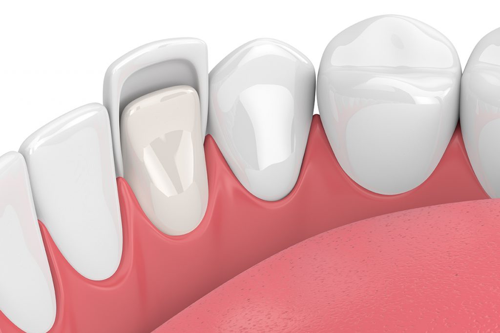 dental veneers in turkey 