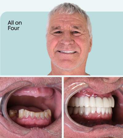 mcan dental before and after 1