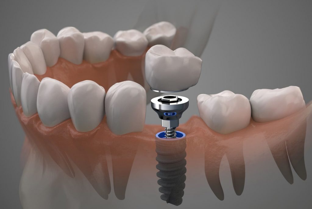 dental implant treatments in turkey