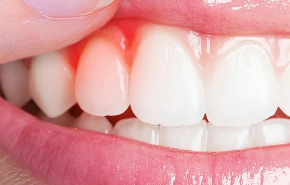 Image showing gum infection.