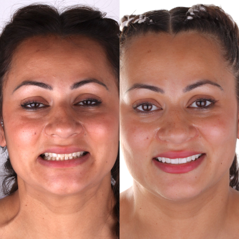 Tina's before and after picture after having emax veneers.