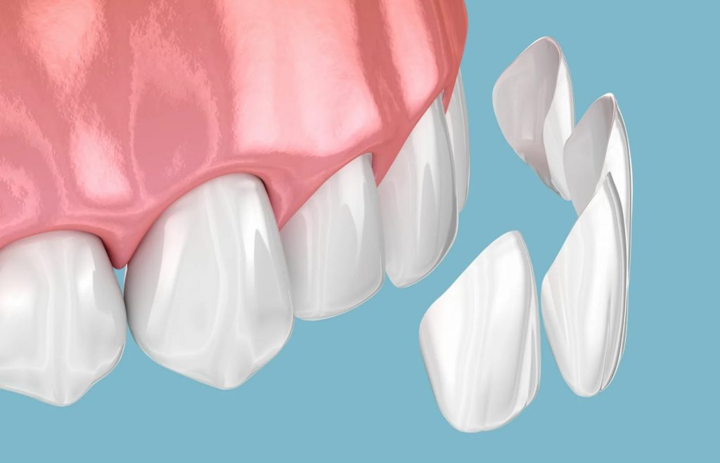 how porcelain veneers look