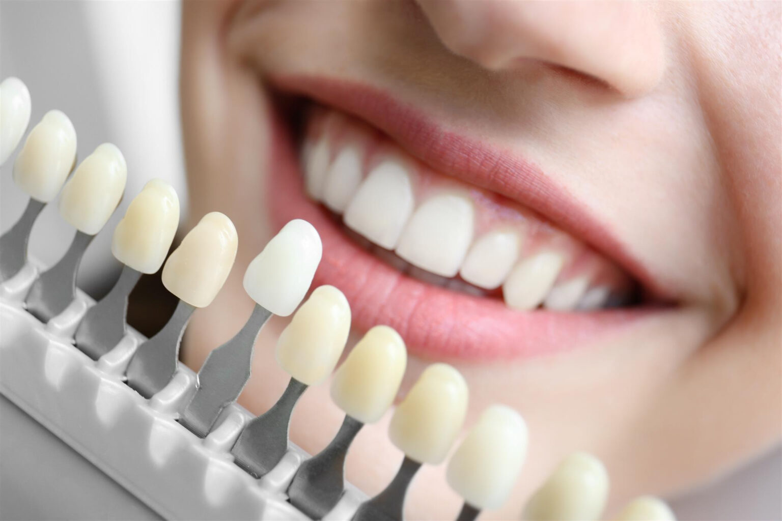 how long do veneers last?