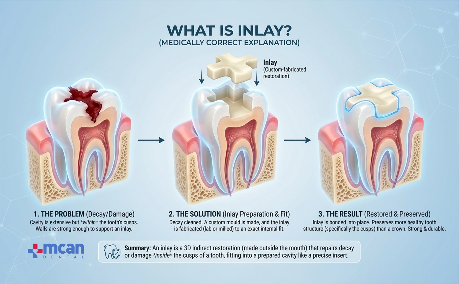 Dental Inlays and Onlays Explained: The Overlooked Solution for Damaged ...