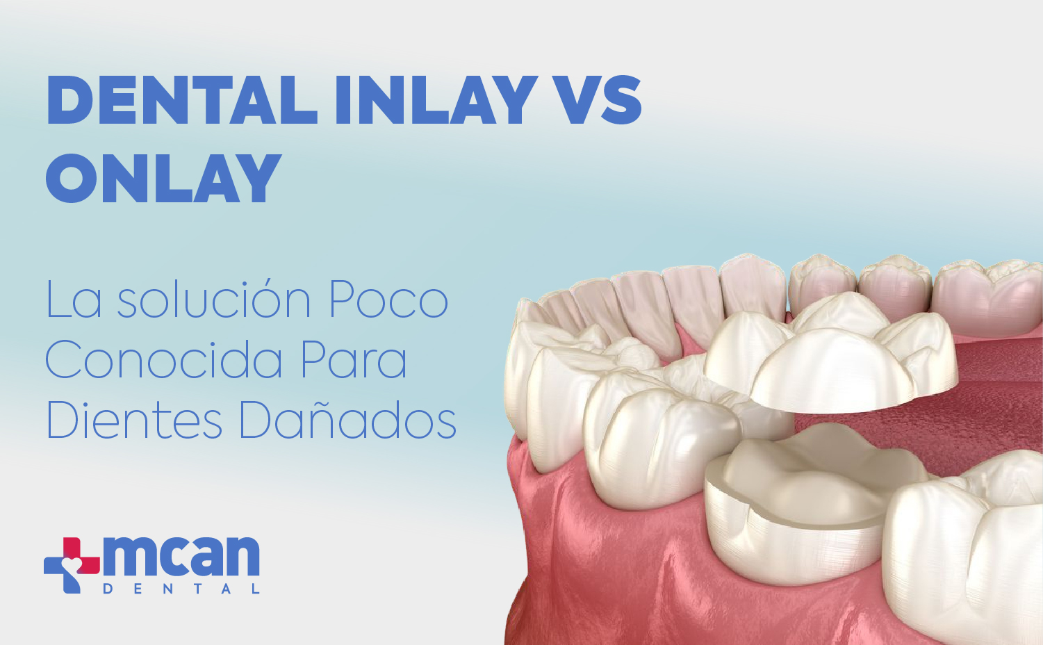 Dental inlay vs onlay: la solución poco conocida para dientes dañados
