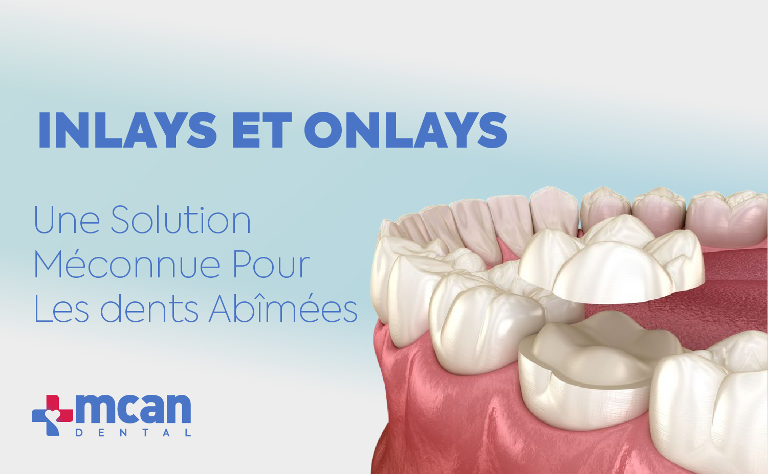Inlays et onlays : une solution méconnue pour les dents abîmées