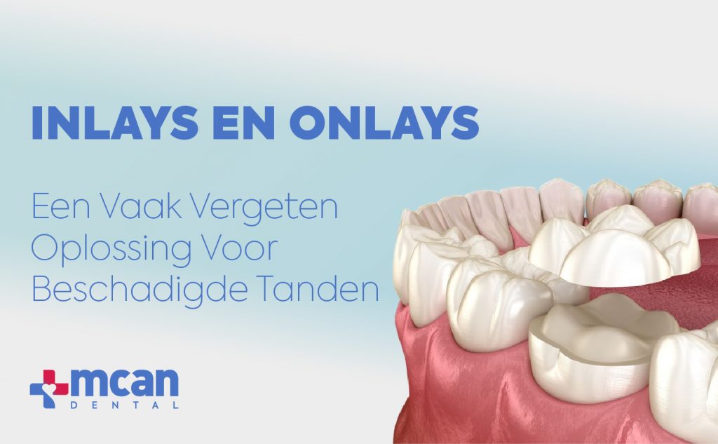 Inlays en onlays: een vaak vergeten oplossing voor beschadigde tanden