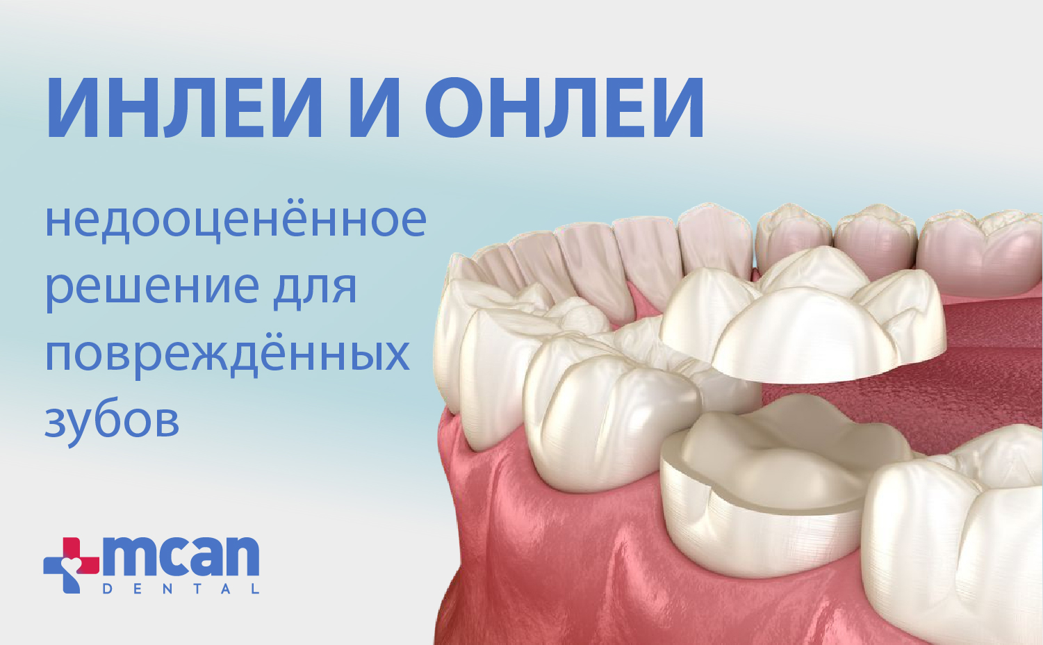 Инлеи и онлеи: недооценённое решение для повреждённых зубов