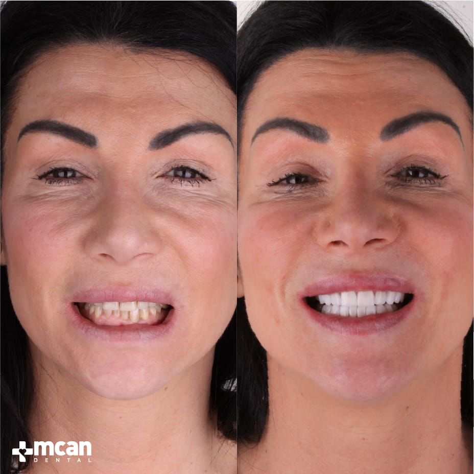 Carillas en Turquía con MCAN Dental